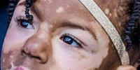 White Skin Disease