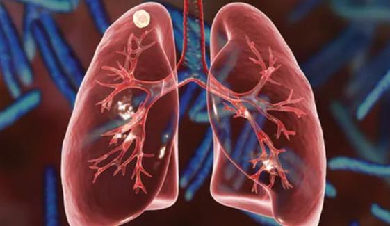 Tuberculosis