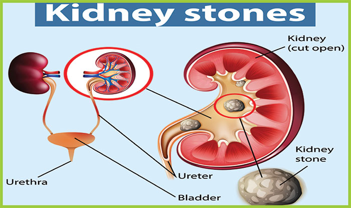 گرد ے کی پتھری...  علامات، وجوہات اور احتیاط کیا ہیں؟