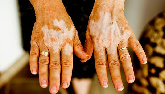 برص: تکلیف دہ مرض ہے، نہ ناقابلِ علاج