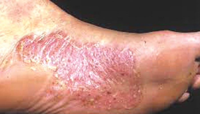 فنگس یاداد... ایک متعدی مرض