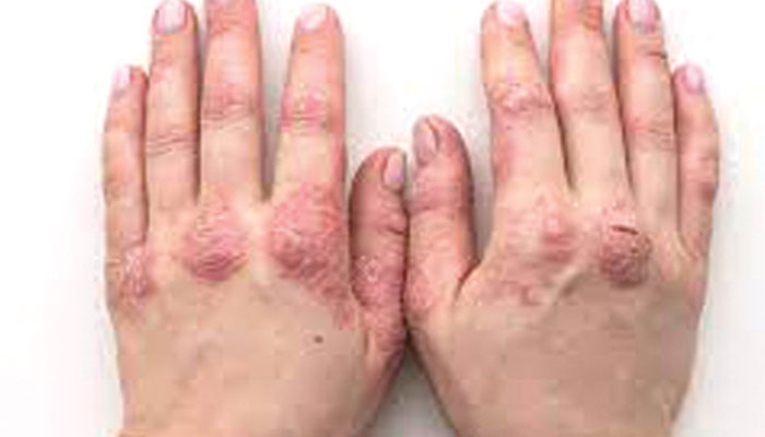 فنگس یاداد... ایک متعدی مرض