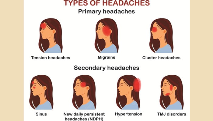 سر درد اور اس کی اقسام