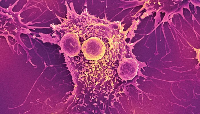 سرطان: علاج کے جدید طریقے