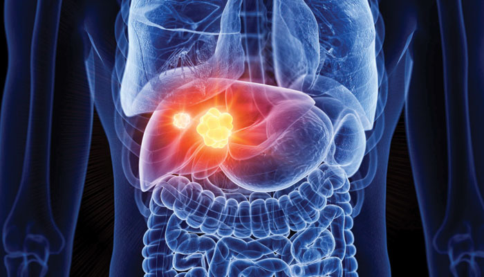 جگر کا سرطان: دنیا بھر میں اموات کا چوتھا بڑا سبب