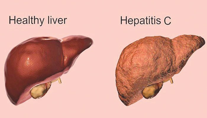 ہیپاٹائٹس کی وجوہات، علاج اور بچاؤ