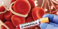 ہیموفیلیا ایک جینیاتی مرض