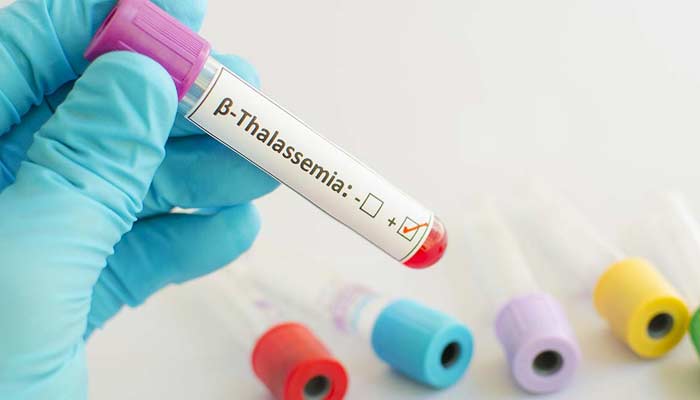 شادی سے قبل جوڑے کا تھیلیسیمیا ٹیسٹ