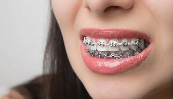 مسکراہٹ کے دشمن، ٹیڑھے میڑھے دانت