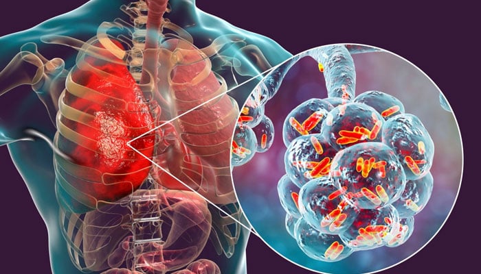 جی ہاں! ہم ٹی بی کا خاتمہ کرسکتے ہیں
