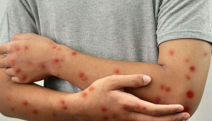 ایم پاکس: خطرناک وبائی بیماری