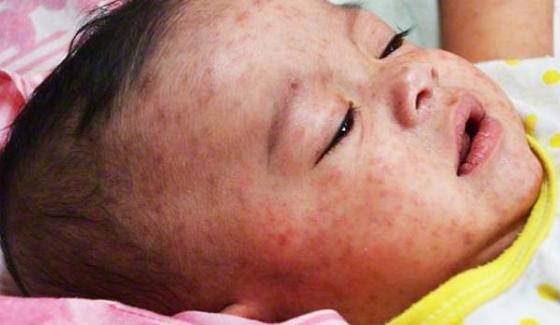 Chaman Measles Killed Two Child