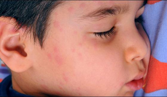 300 Childrens Affected By Measles