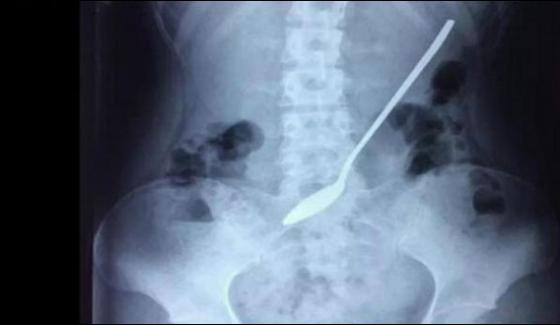 Chinese Doctors Removed Spoon From Students Stomach