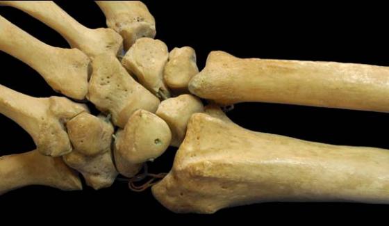Bones Diseases Comes With Eating Habits And Environment