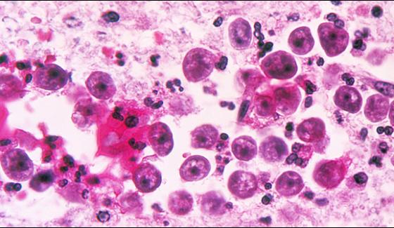 Naegleria Is An Amoeba That Cause Brain Infection