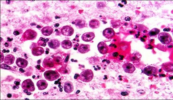 Naegleria Claims Another Life In Karachi