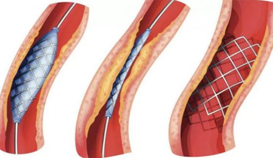Usage Of Stents Increased In The Country