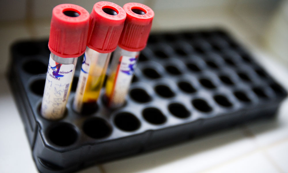 سائنس دانوں نے ایڈز کے علاج کی خوش خبری سنادی