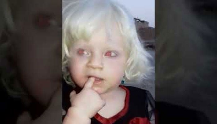 لال آنکھوں، سفید بالوں والی دُنیا کی واحد بچی