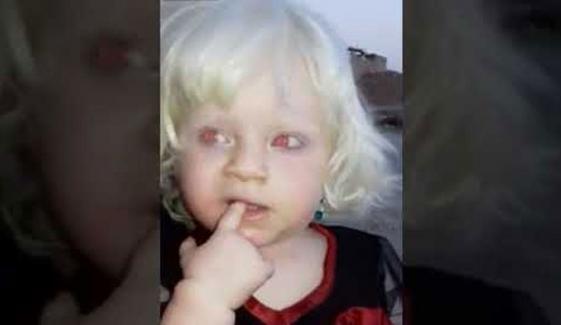 لال آنکھوں، سفید بالوں والی دُنیا کی واحد بچی