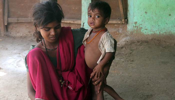 بھارت میں 21فیصد بچوں کا وزن تشویشناک حد تک کم 
