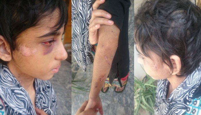 راولپنڈی :کمسن کنزہ پر تشدد کی تصدیق ،مقدمہ درج 