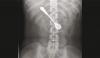 Woman Swallows Metal Spoon Stays In Body For Days