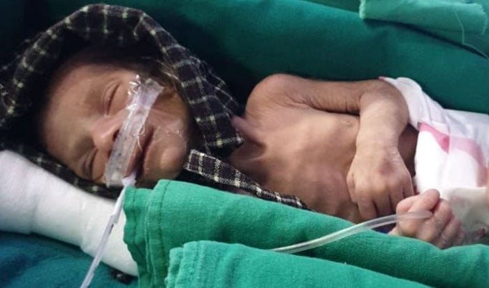 بھارت :زندہ دفن کی گئی نومولود بچی کو بچالیا گیا 