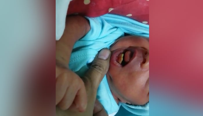 کراچی: دو دانت کیساتھ بچے کی پیدائش 