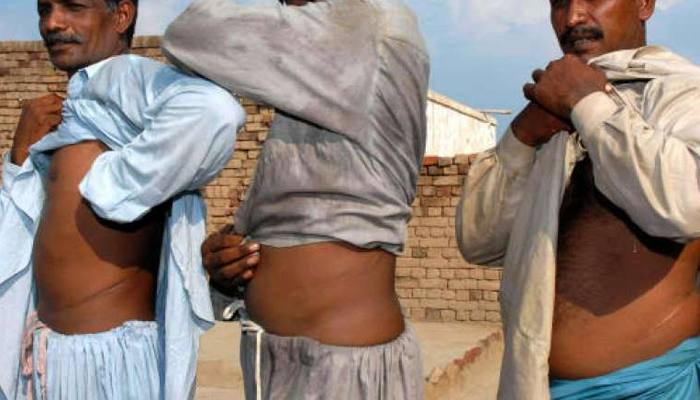 لالچ دیکر 5 افراد کے گردے نکال لیے گئے