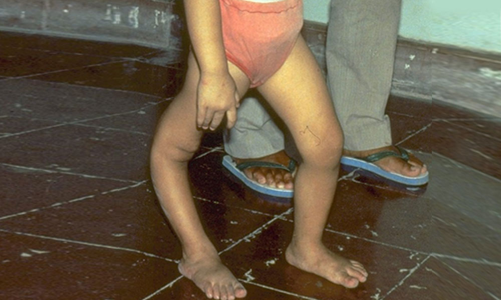 کشمور کی 3 سالہ بچی میں پولیو وائرس کی تصدیق 