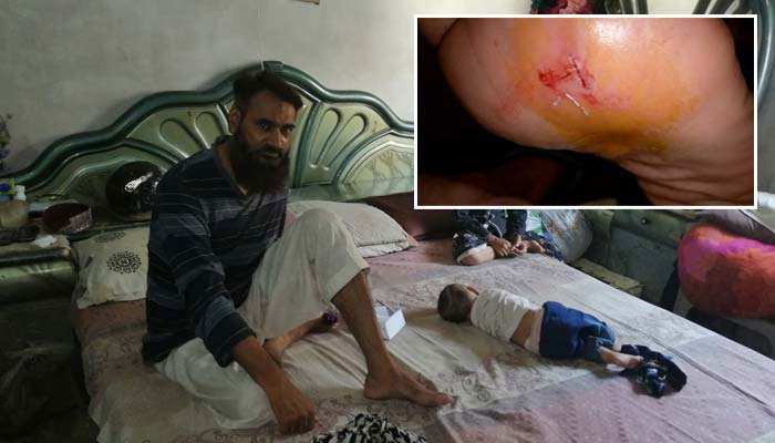 کراچی، عزیز آباد میں آوارہ کتوں کے کاٹنے سے 3 افراد زخمی