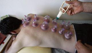 حجامہ ’کپنگ تھیراپی‘ کروانے کے فوائد