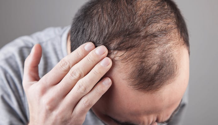 Will they ever find a cure for baldness?