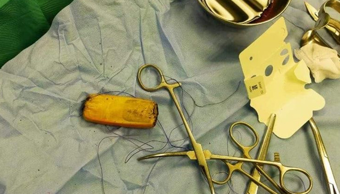 مصر، مریض کا نگلا فون ڈاکٹروں نے 6 ماہ بعد پیٹ سے نکال لیا