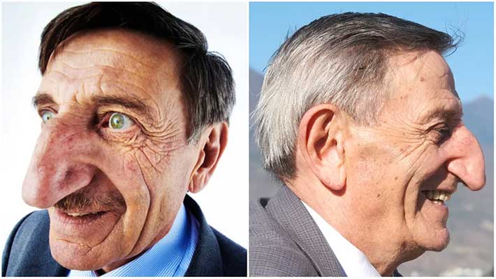 دنیا میں سب سے لمبی انسانی ناک کا عالمی ریکارڈ بن گیا
