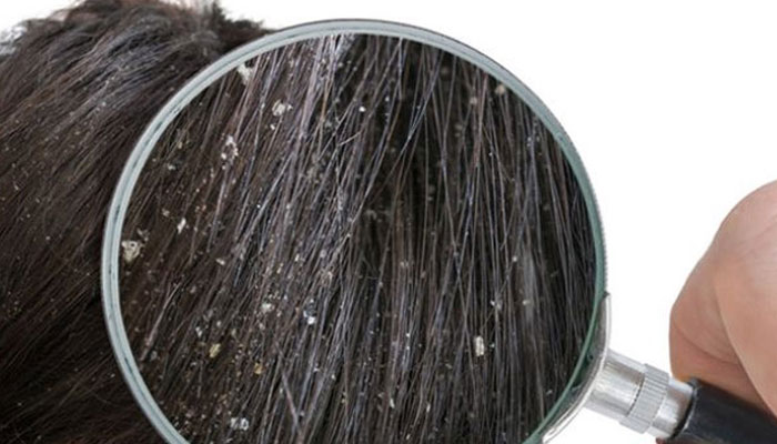 بالوں کی خشکی کے مسئلہ کا حل