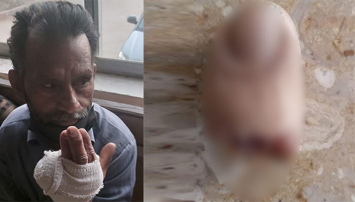 کراچی میں پسند کی شادی کے تنازع پر لڑکی کے باپ نے جھگڑے کے دوران دانتوں سے لڑکے کے والد کی انگلی کاٹ دی