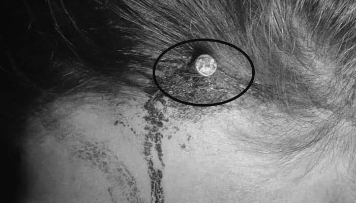 سر میں کیل ٹھونکنے کا معاملہ: خاتون کا ماہر نفسیات سے طبی معائنہ کروایا گیا
