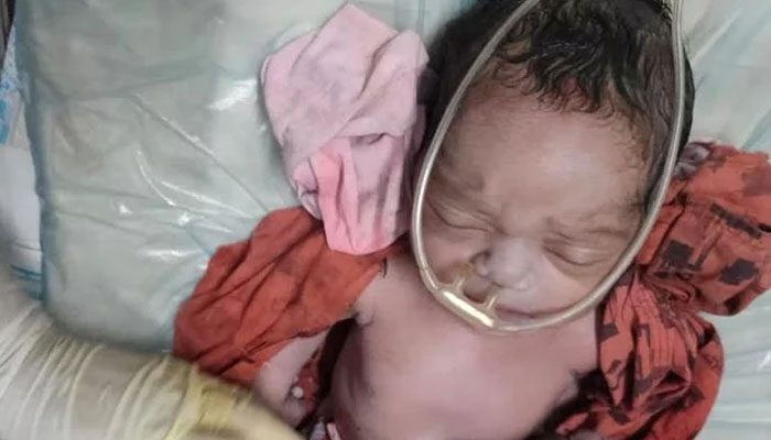 بھارت: 4 ہاتھوں، 4 پیروں والی بچی کی پیدائش