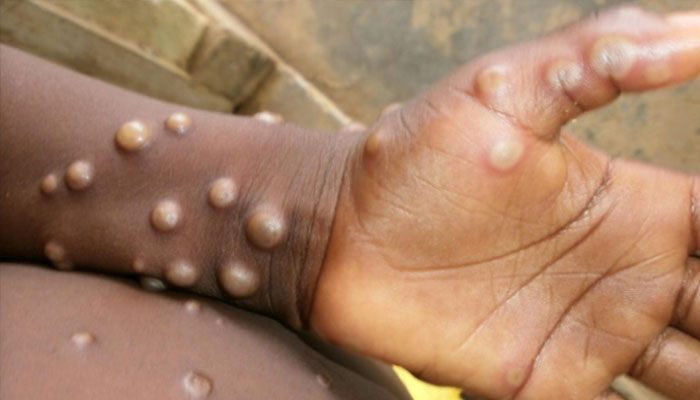 امریکا،2 بچوں میں منکی پاکس وائرس کا پہلا کیس رپورٹ
