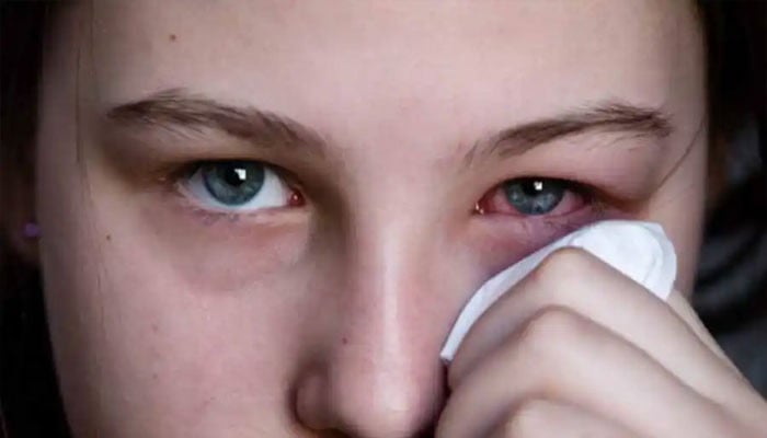 کراچی میں آشوب چشم کی وباء میں تیزی سے اضافہ