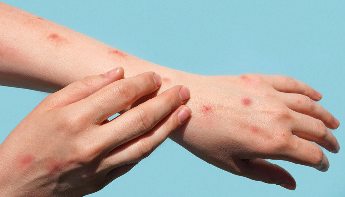 عالمی ادارۂ صحت کی پاکستان کو منکی پاکس کی ادویات دینے کی یقین دہانی عالمی ادارۂ صحت کی پاکستان کو منکی پاکس کی ادویات دینے کی یقین دہانی