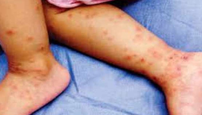 سجاول، گاؤں طالب رچھو میں خسرہ سے 4 بچے جاں بحق سجاول، گاؤں طالب رچھو میں خسرہ سے 4 بچے جاں بحق