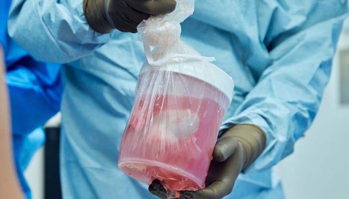 Successful pig kidney transplant into living man