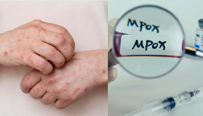 Mpox cases rising in the US again