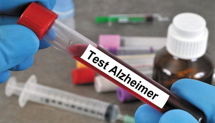 New blood test surpasses doctors in identifying early-stage Alzheimer’s