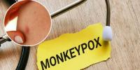 خیبر پختونخوا میں منکی پاکس کا کیس سامنے آگیا
