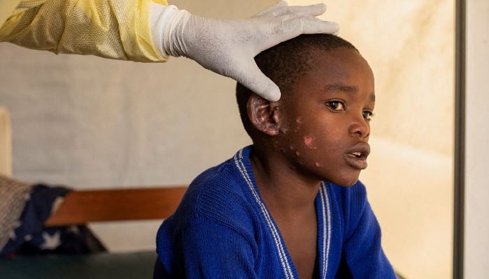 Mpox: Africa CDC reacts strongly to alarming 107 new deaths